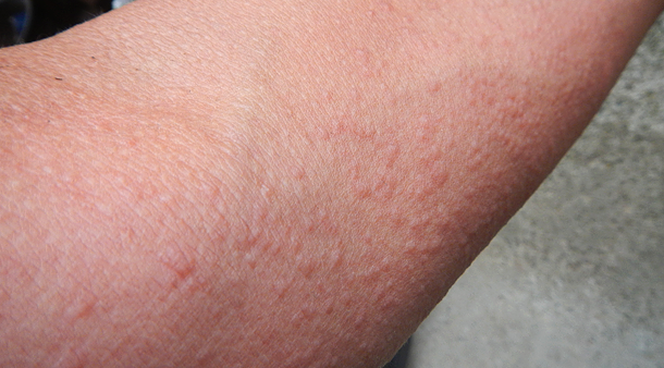 前腕の蕁麻疹